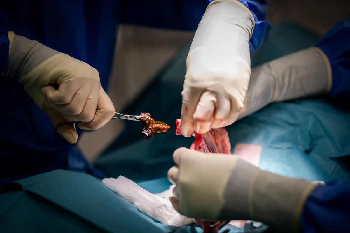 Der Chirurg entfernt das Plastikstück mit einer Zange aus dem Darm.
